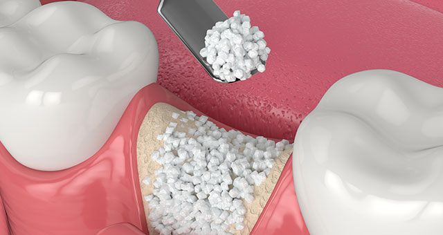 インプラント治療で骨量が足りない場合に必要な骨造成とは
