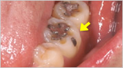 奥歯の咬耗