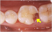 奥歯の歯冠破折