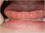 舌の圧痕