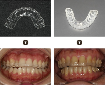 ナイトガードでの治療