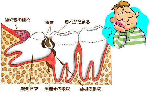 親知らずを抜歯した方が良い場合