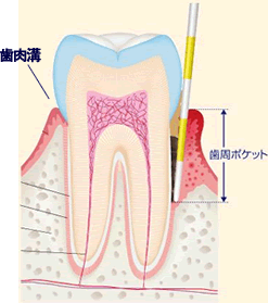 歯周病とは？