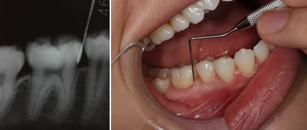 歯周組織検査