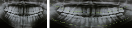 歯周病のレントゲン写真