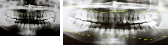 歯周病のレントゲン写真