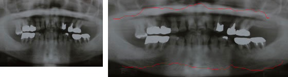 歯周病のレントゲン写真