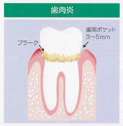 歯肉炎