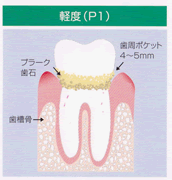 軽度(P1)