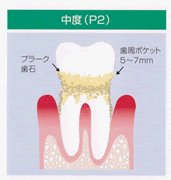 中度(P2)