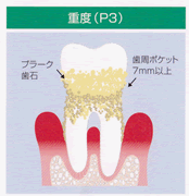 重度(P3)