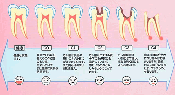 虫歯を放置しておくと