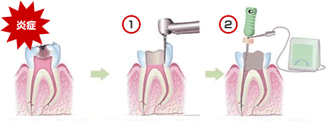 抜髄(歯の神経を取る治療)
