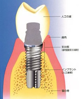 インプラント