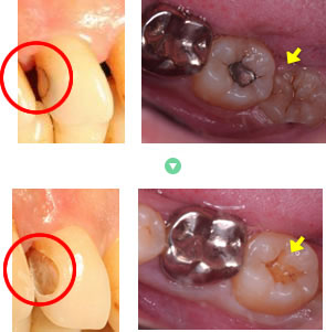 虫歯や被せ物を除去