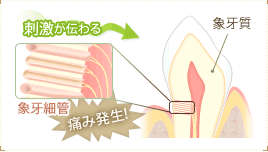 知覚過敏