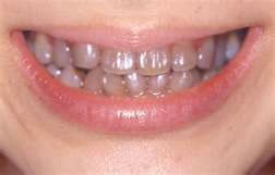 歯の変色の原因